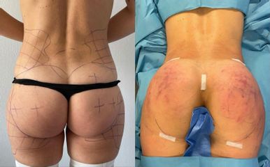 Gluteoplastica - Clinica DaVINCI