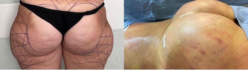 Gluteoplastica - Clinica DaVINCI