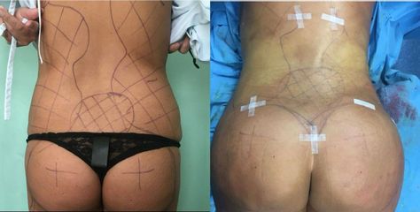 Gluteoplastica - Clinica DaVINCI