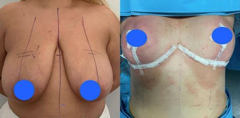 Mastoplastica riduttiva - Clinica DaVINCI