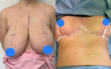 Mastoplastica riduttiva - Clinica DaVINCI