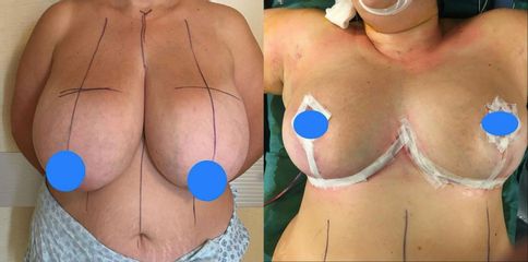 Mastoplastica riduttiva - Clinica DaVINCI
