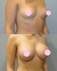 Mastoplastica additiva - Clinica DaVINCI