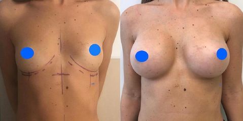 Mastoplastica additiva - Clinica DaVINCI
