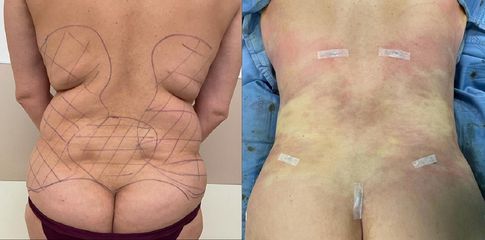 Liposuzione  - Clinica DaVINCI