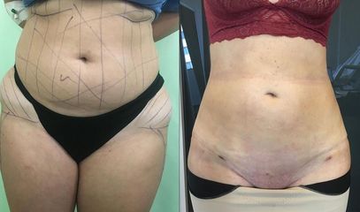 Liposuzione  - Clinica DaVINCI