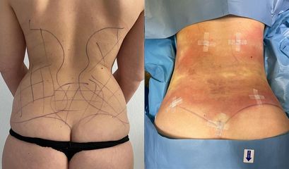 Liposuzione  - Clinica DaVINCI