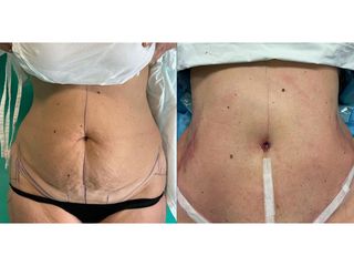 Addominoplastica - Clinica DaVINCI