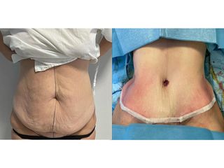 Addominoplastica - Clinica DaVINCI