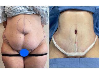 Addominoplastica - Clinica DaVINCI