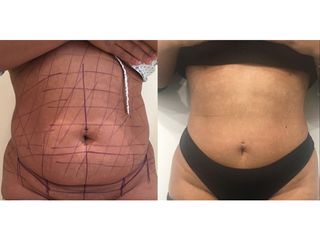 Addominoplastica - Clinica DaVINCI
