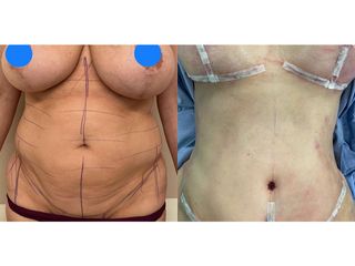 Addominoplastica - Clinica DaVINCI