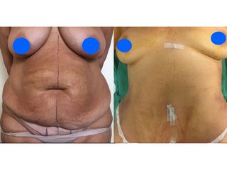 Addominoplastica - Clinica DaVINCI