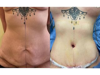 Addominoplastica - Clinica DaVINCI