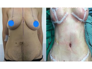 Addominoplastica - Clinica DaVINCI