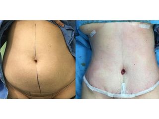 Addominoplastica - Clinica DaVINCI