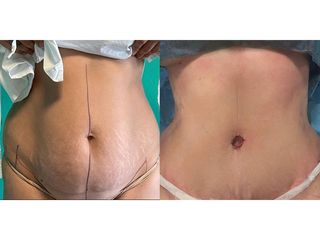 Addominoplastica - Clinica DaVINCI