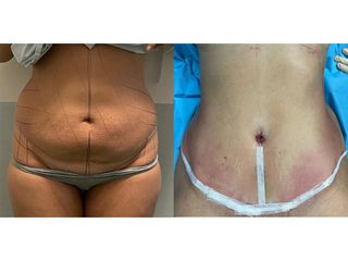 Addominoplastica - Clinica DaVINCI