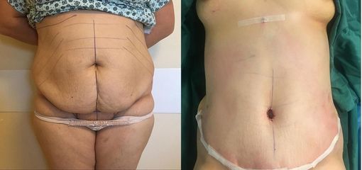 Addominoplastica - Clinica DaVINCI
