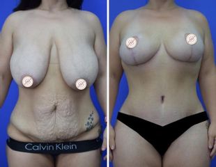 Addominoplastica - Clinica DaVINCI