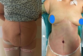 Addominoplastica - Clinica DaVINCI