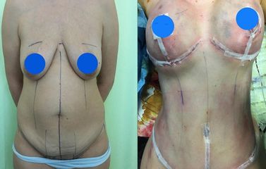 Addominoplastica - Clinica DaVINCI