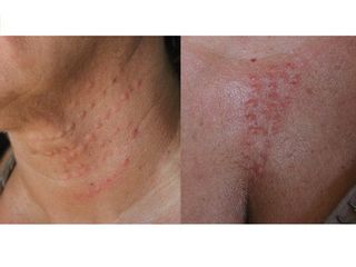 Biostimolazione cutanea trattamenti