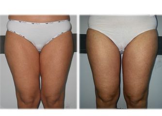 Lifting cosce prima e dopo