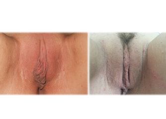 Labioplastica prima e dopo