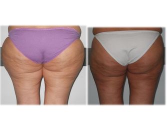 Liposuzione prima e dopo
