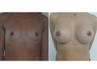 Mastoplastica additiva prima e dopo