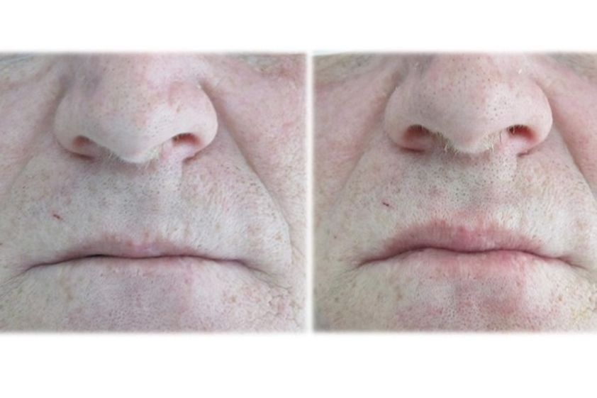 Filler labbra prima e dopo - 749711
