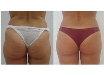 Liposcultura prima e dopo