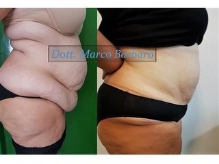 Addominoplastica prima e dopo