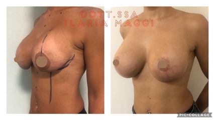 Sostituzione protesi mammarie - Dott.sa Ilaria S. Maggi