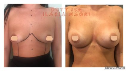 Mastoplastica additiva - Dott.sa Ilaria S. Maggi