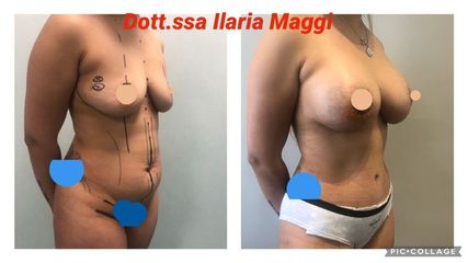 Liposcultura - Dott.sa Ilaria S. Maggi