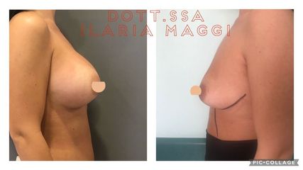 Mastoplastica additiva - Dott.sa Ilaria S. Maggi
