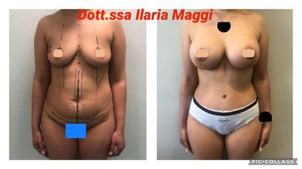 Liposcultura - Dott.sa Ilaria S. Maggi