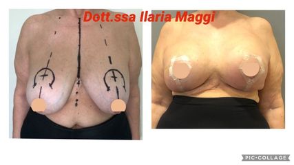 Mastoplastica riduttiva - Dott.sa Ilaria S. Maggi