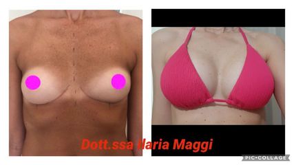 Mastoplastica additiva - Dott.sa Ilaria S. Maggi