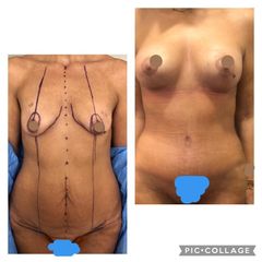 Liposcultura - Dott.sa Ilaria S. Maggi