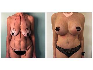 Liposcultura -Dott.sa Ilaria S. Maggi