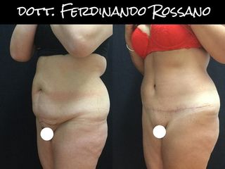 Addominoplastica prima e dopo