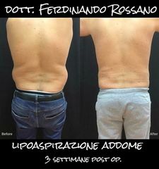 Liposuzione prima e dopo