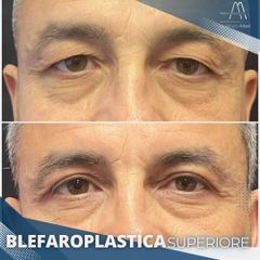 Blefaroplastica - Dott. Alfredo Altieri