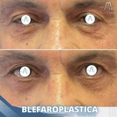 Blefaroplastica - Dott. Alfredo Altieri