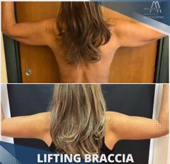 Lifting braccia - Dott. Alfredo Altieri