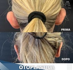 Otoplastica - Dott. Alfredo Altieri