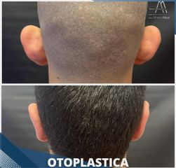 Otoplastica - Dott. Alfredo Altieri